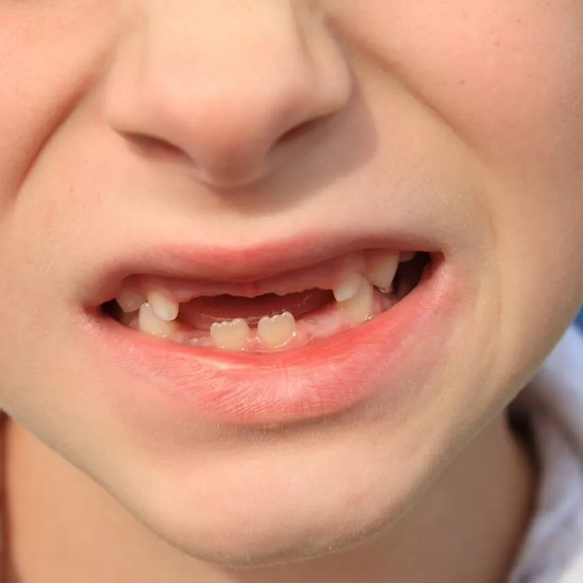 Lumineers no-prep ultra-thin veneers at Pro Estetik Dental Clinic Izmir Turkey